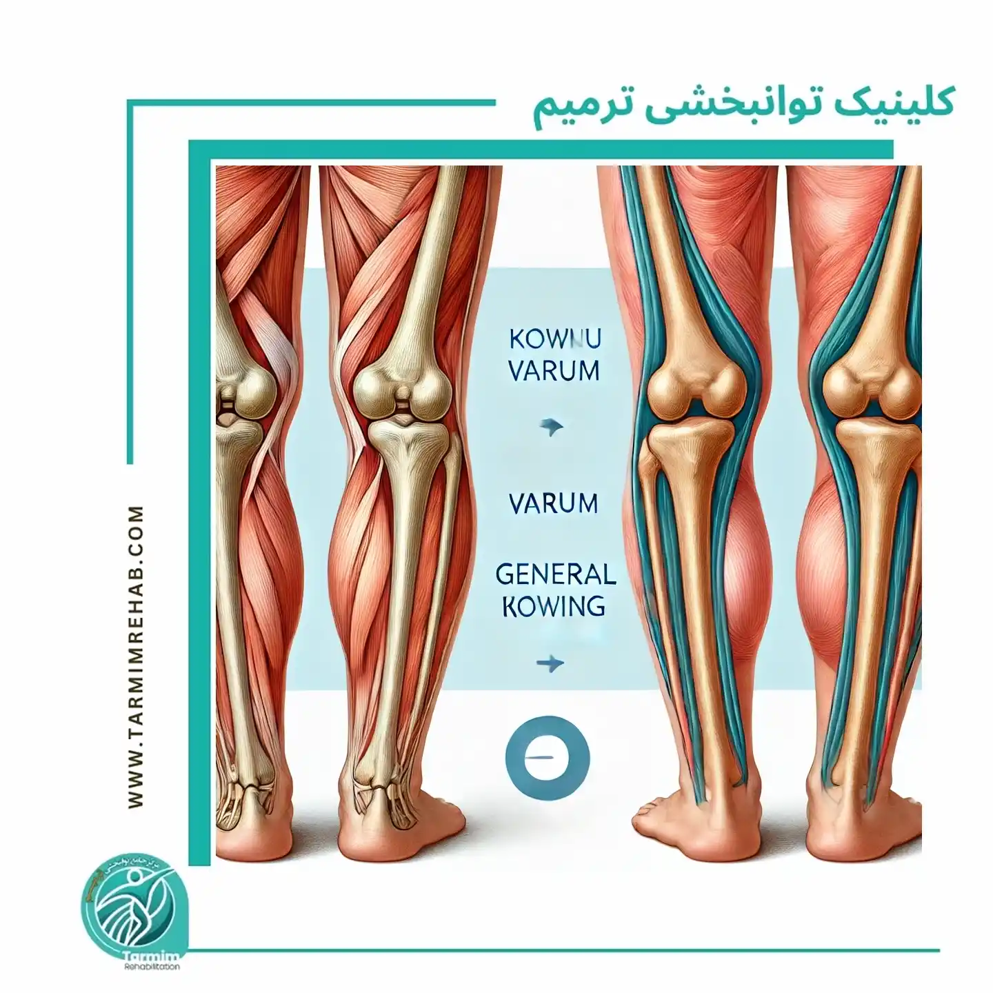 مقایسه تصویری بین پای پرانتزی و زانوی پرانتزی