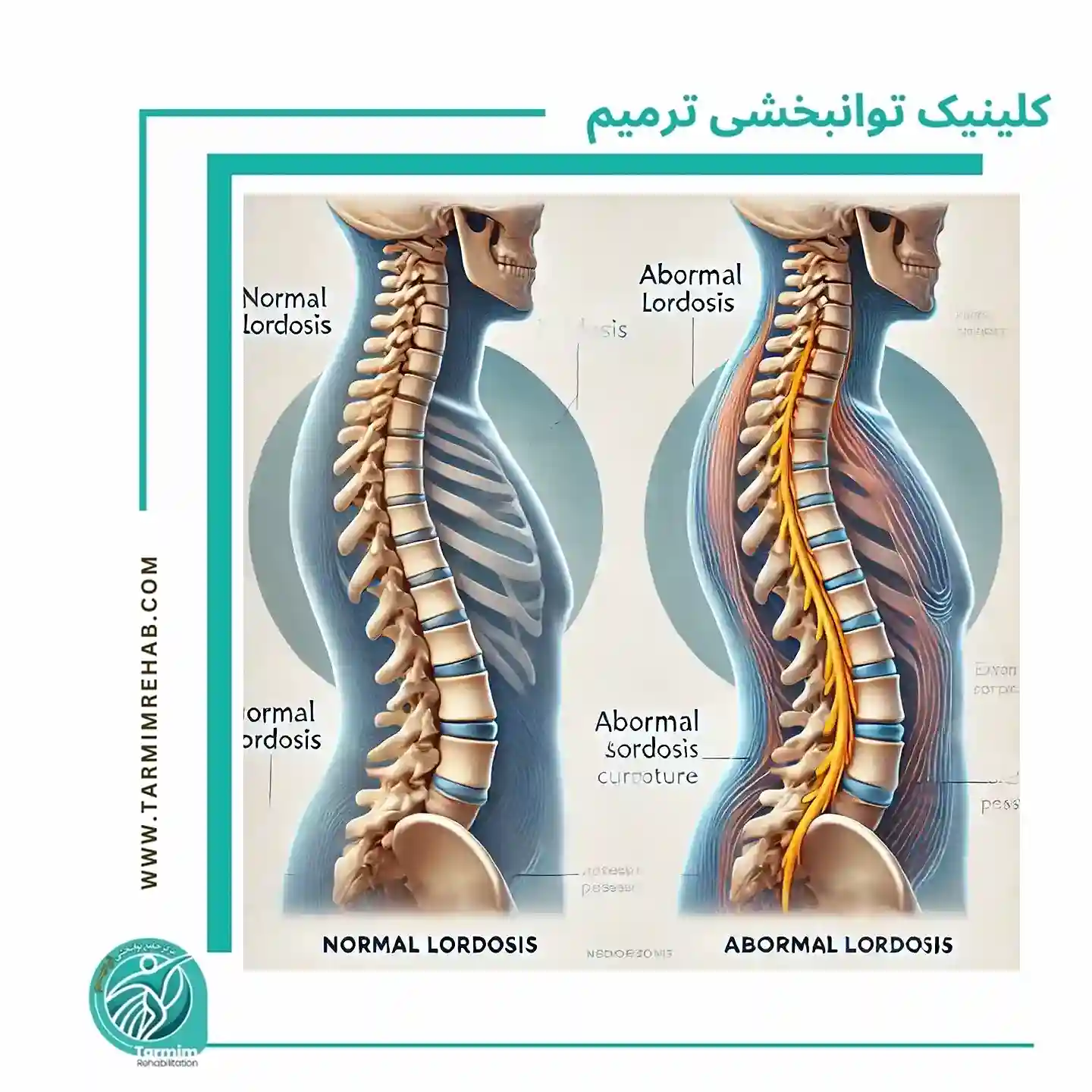 تفاوت بین گودی کمر طبیعی و غیرطبیعی