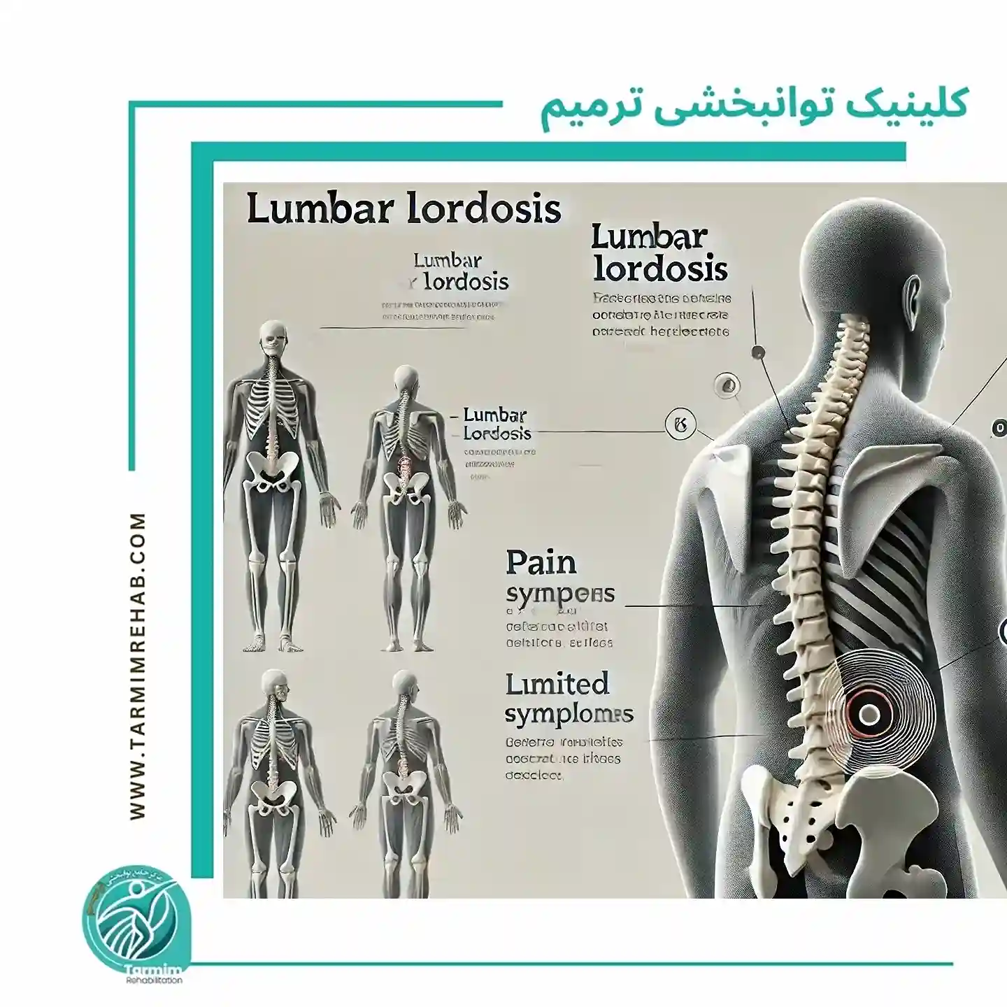 تعریف و علائم گودی کمر به زبان ساده