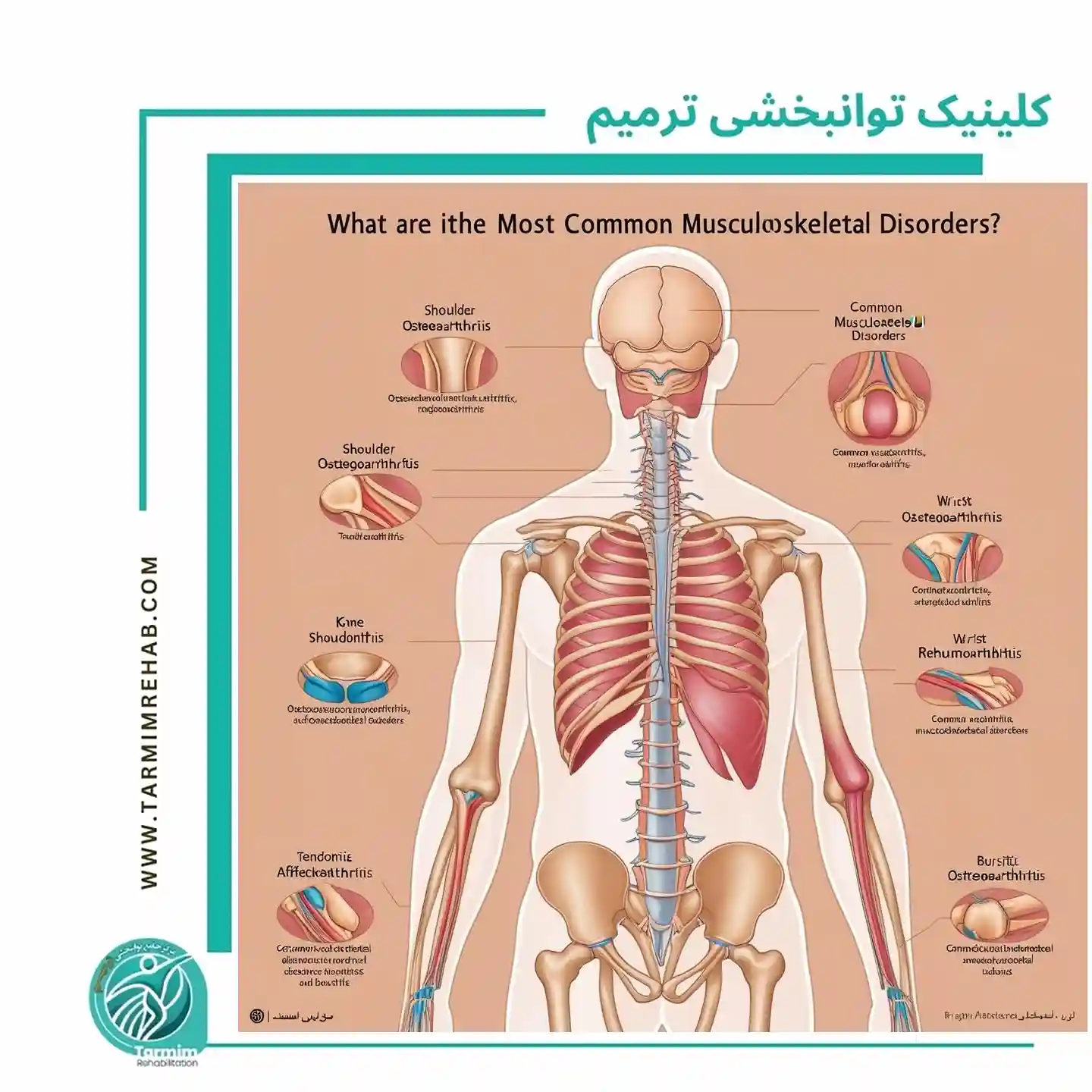 شایع‌ترین اختلالات اسکلتی عضلانی کدام‌اند؟