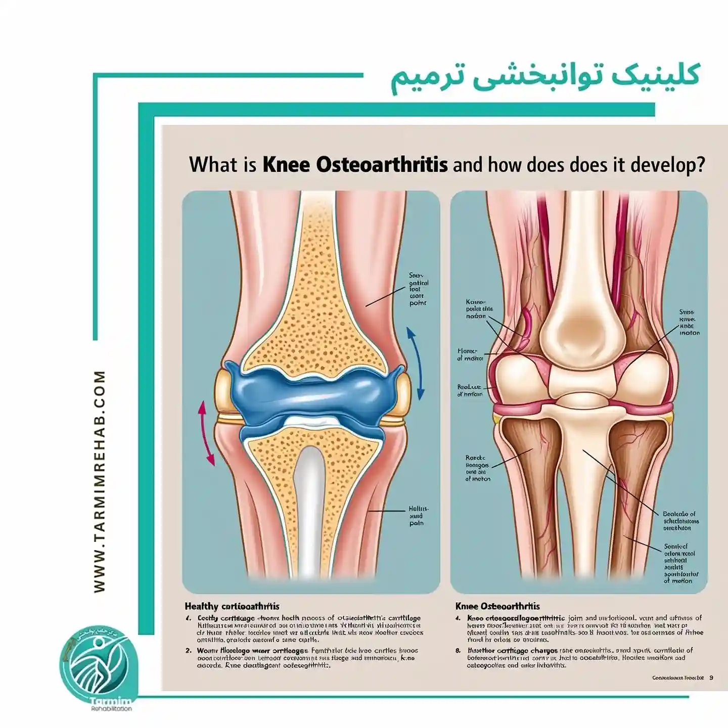  نمودار تصویری از علل و علائم آرتروز زانو