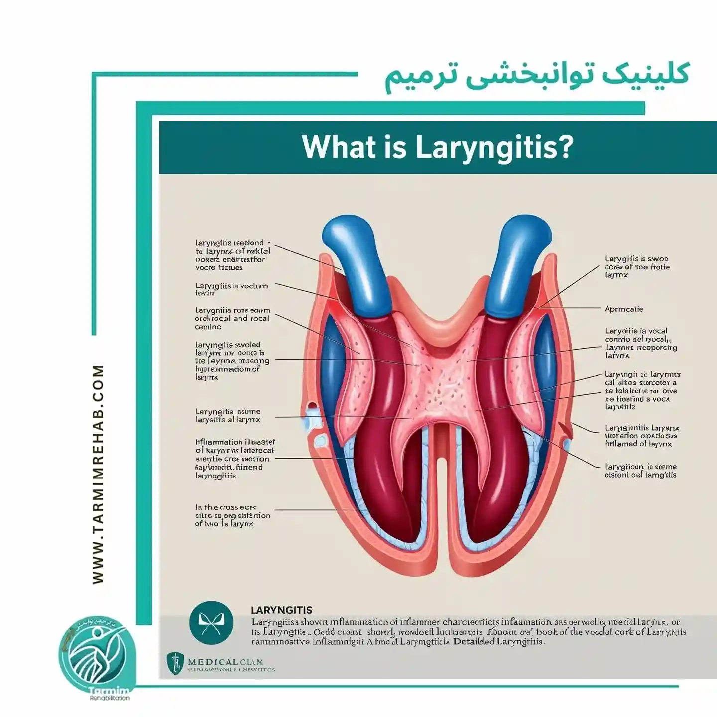  توضیح لارنژیت و علائم آن