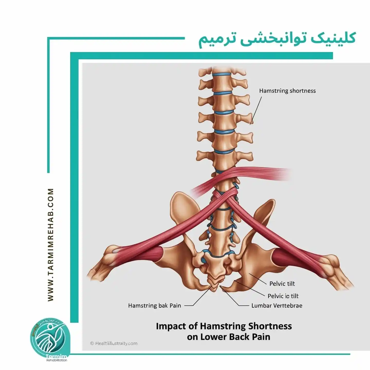 تأثیر کوتاهی همسترینگ بر کمردرد