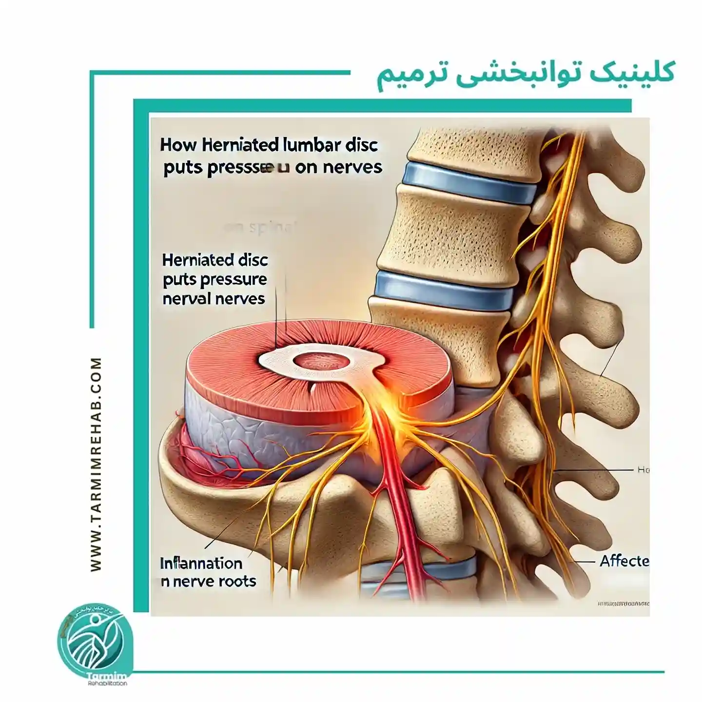"دیسک کمر چگونه باعث فشار روی اعصاب می‌شود؟"