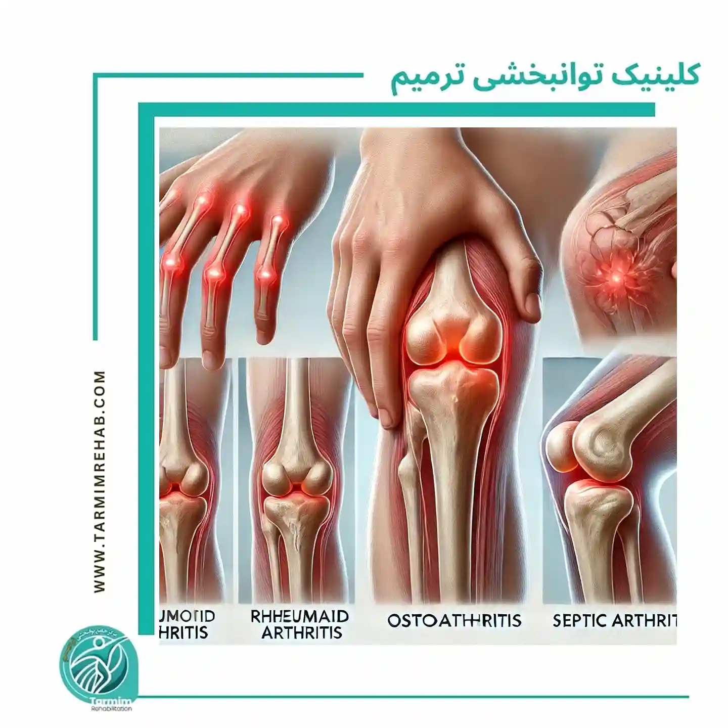 نشانه‌های اولیه انواع آرتروز