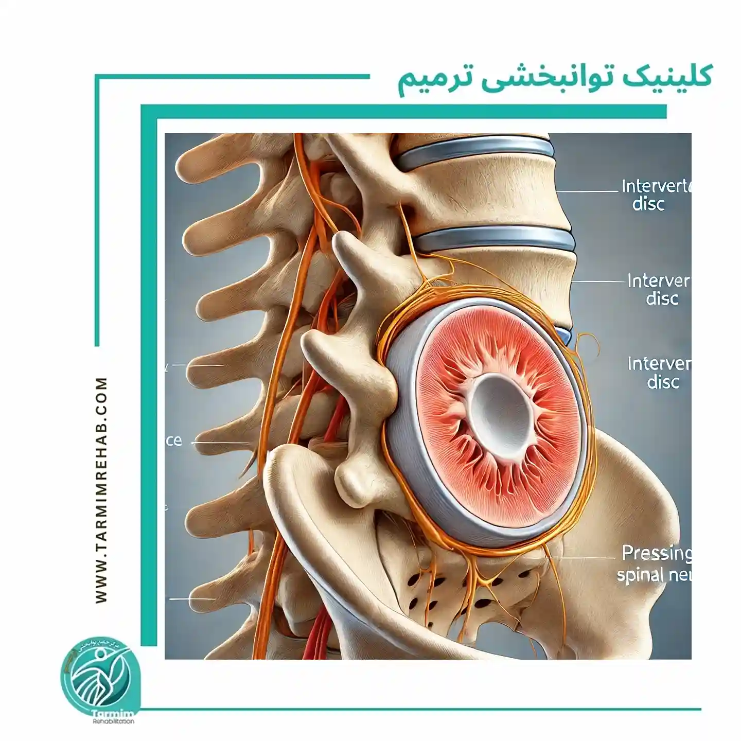 نمای گرافیکی از دیسک کمر و اعصاب.