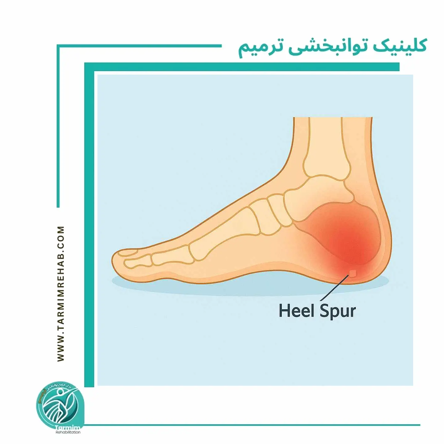 چرا خار پاشنه ایجاد می‌شود و بهترین درمان‌های غیرجراحی چیست؟