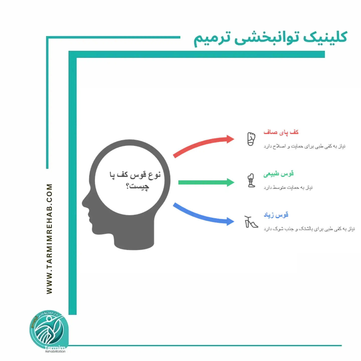 تصویر مقایسه انواع قوس کف پا شامل کف پای صاف، قوس طبیعی و قوس زیاد